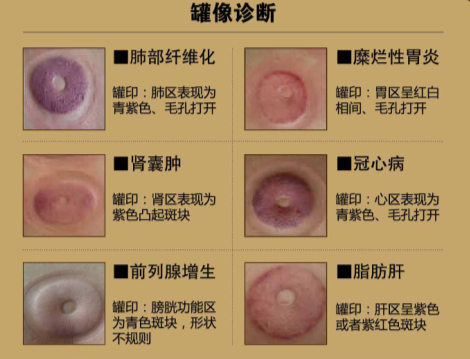 拔火罐有坏处_拔火罐出水泡_脑门拔火罐_脑门1拔火罐 ...